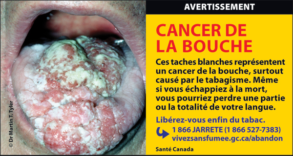 Canada 2012  Health Effects mouth - mouth cancer, gross - fr